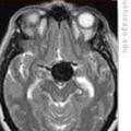 Brain Aneurysms: Rare but Usually Deadly If They Burst